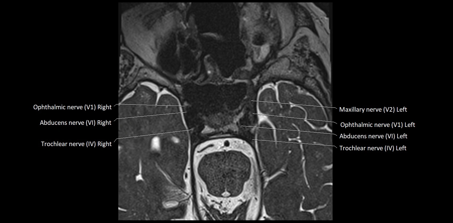 Cranial nerve anatomy axial MRI 3T image 32.webp